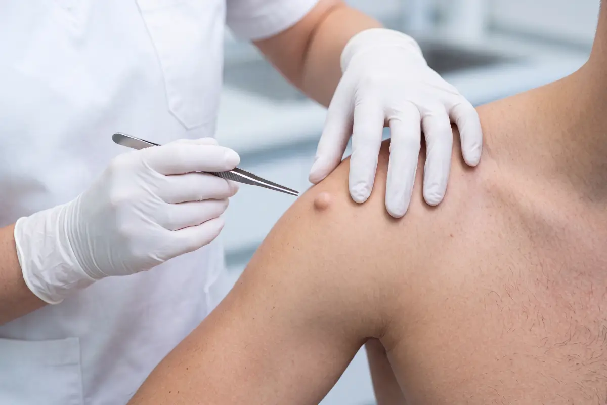 Poliklinika Beograd | Atheroma removal