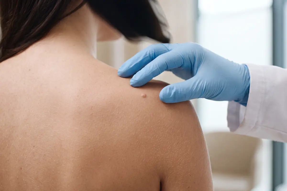 Poliklinika Beograd | Skin lesions