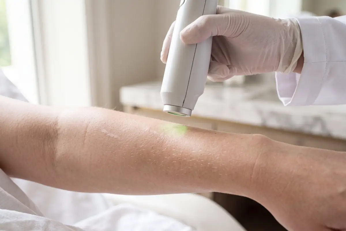 Poliklinika Beograd | Removal of stretch marks, tattoos, scars, and hemangiomas